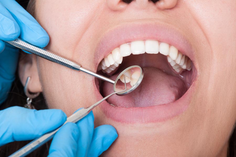 woman at dentist holding mouth open while dentist wearing blue gloves uses mirror to check for gum disease
