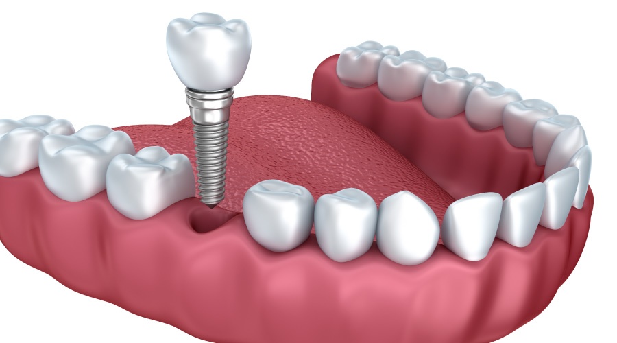 lower jaw model of the dental implant procedure