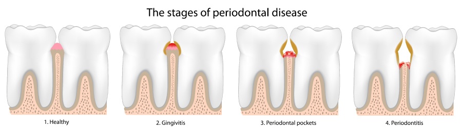 Artistic depiction showing the stages of gum or periodontal disease