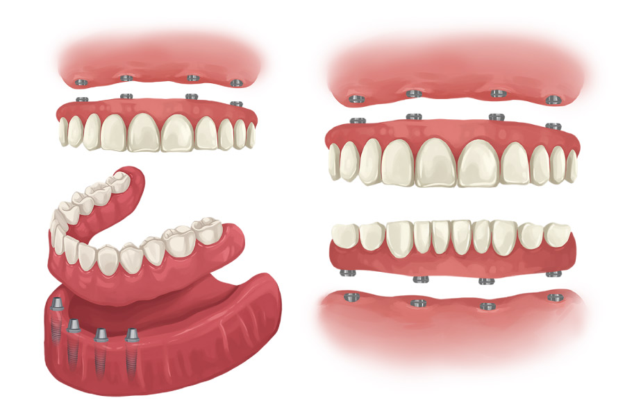 dentures drawing