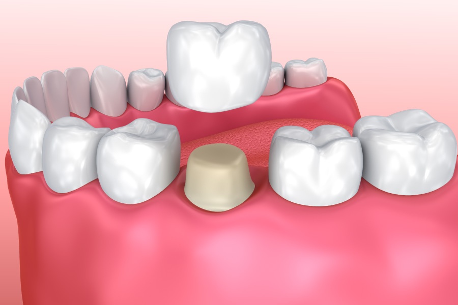 Model of a dental crown being placed on a lower tooth