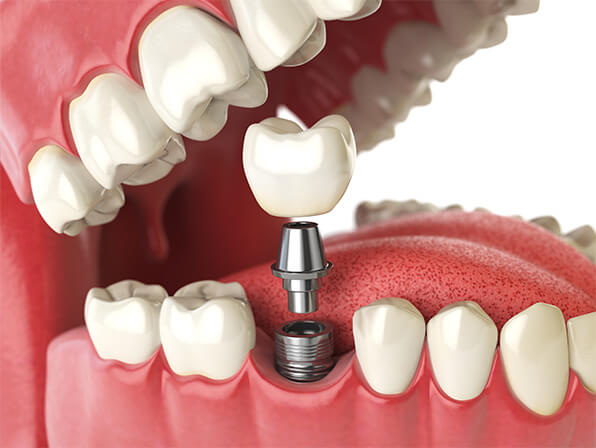 digital image of dental implant
