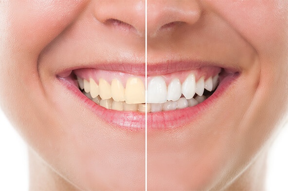 whitening comparative image