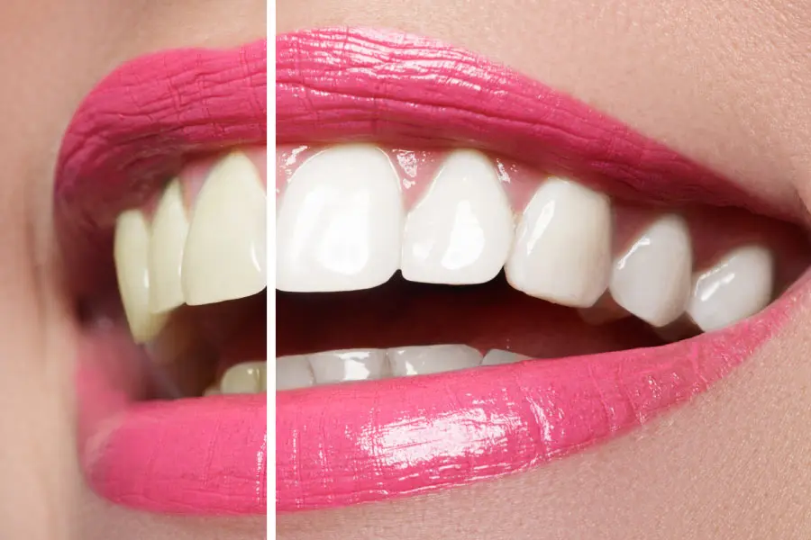 Closeup of a smile split between before teeth whitening and a brighter smile after
