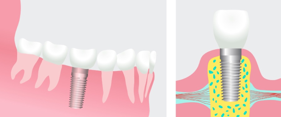 Graphic showing a dental implant fusing into the jaw in one section and topped with a dental crown in the next.