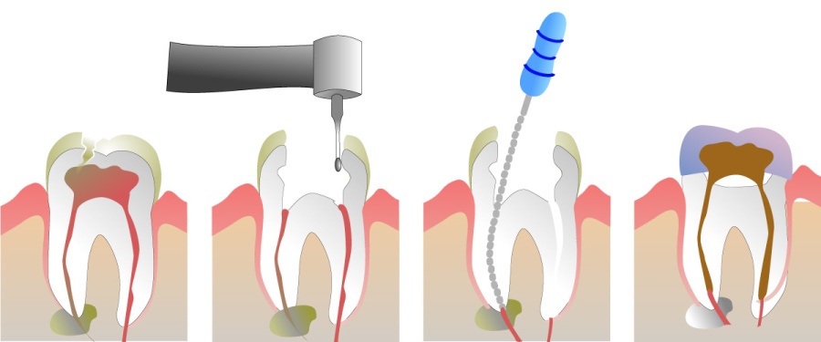 Graphic showing the steps to completing a root canal.