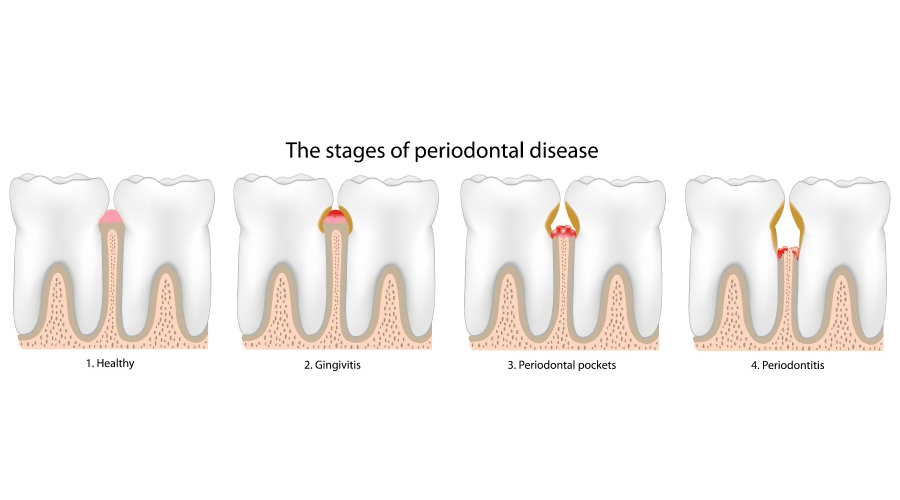 Artistic depiction showing the stages of gum or periodontal disease