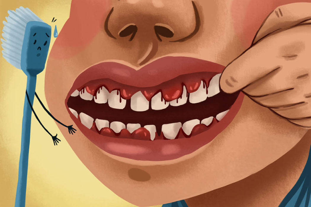 Cartoon showing bleeding gums.