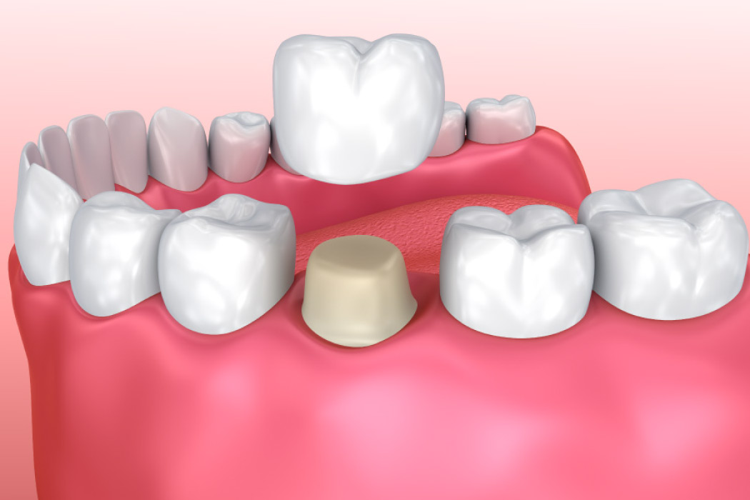 Model of a dental crown.