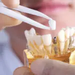 dental implant model being manipulated by a technician
