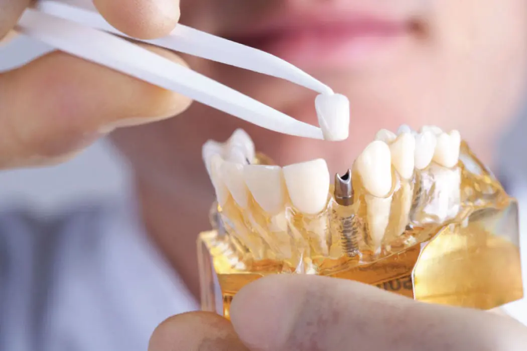 dental implant model being manipulated by a technician