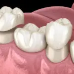 dental crowns, porcelain crowns, ceramic crown, dental crown, porcelain crown, ceramic crowns
