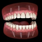 implant supported dentures, all on X dentures, all on 4 dentures