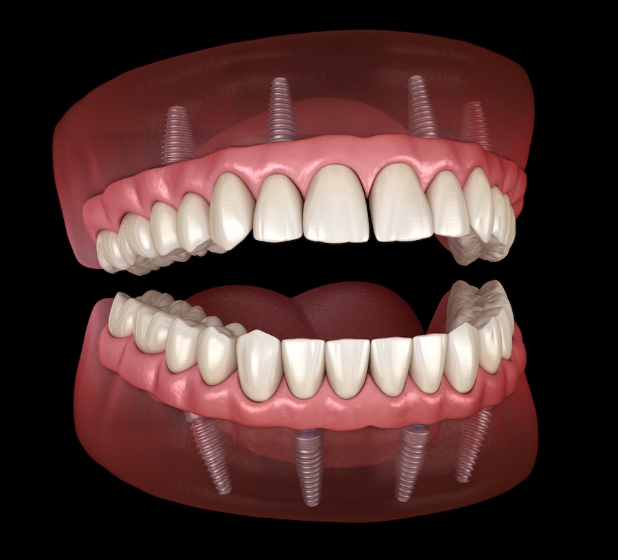 implant supported dentures, all on X dentures, all on 4 dentures