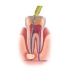 root canal therapy vs extraction