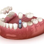 dental crowns, dental implants, dental bridge