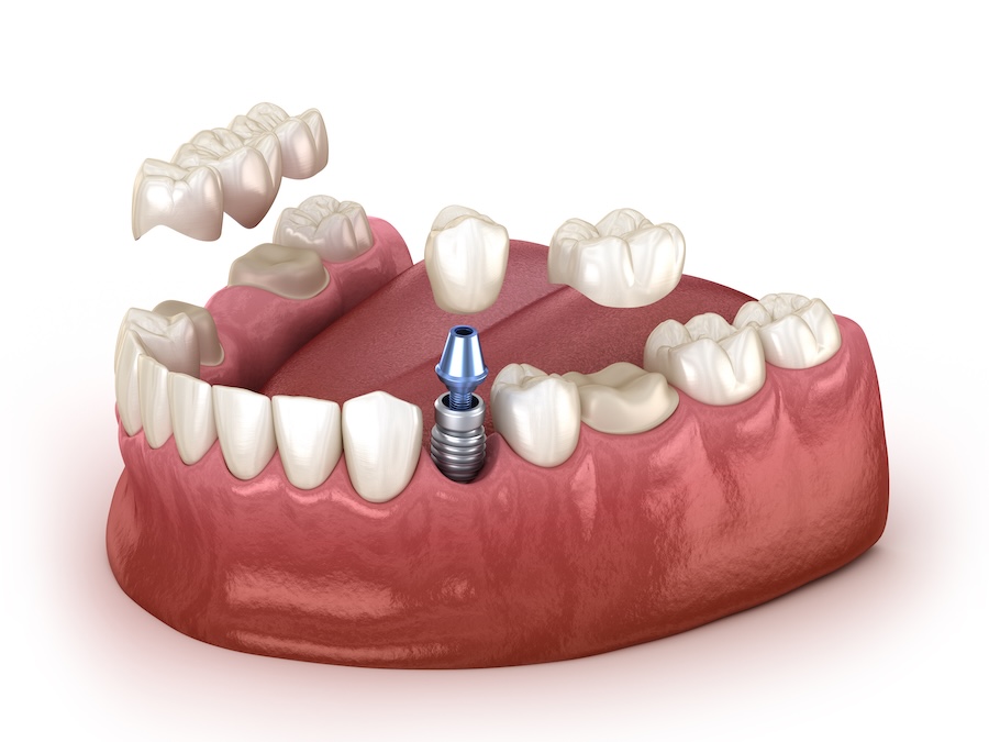 dental crowns, dental implants, dental bridge